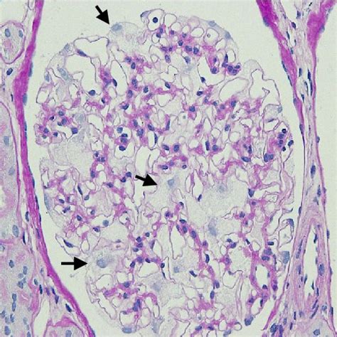 Light Microscopy Of A Renal Biopsy Specimen Showing Diffuse Global
