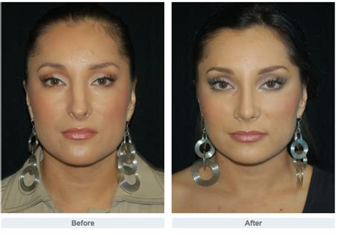 Rhinoplasty Journey Dr Gary Motykie Beverly Hills