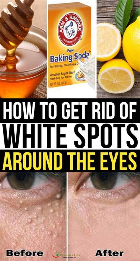 How To Get Rid Of White Spots Around The Eyes Skin Spots Diy Skin