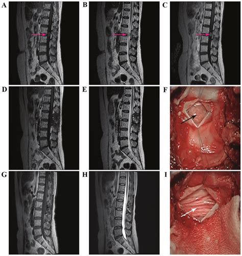 Mri Of The Spinal Cord For Case 3 Identified An Isointense Tumor On