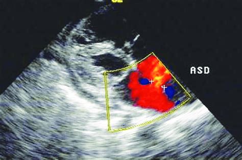 2d Echocardiography Showing Atrial Septal Defect Of Size 121 Mm