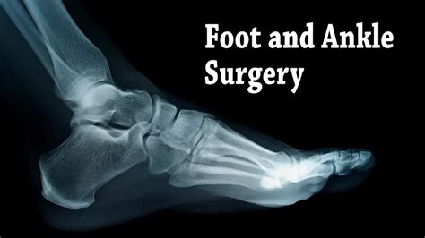 Foot And Ankle Surgery Annapolis And Stevensville Md Podiatrist