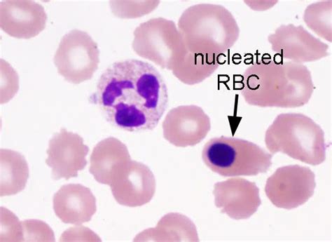 Nucleated Rbc Hematology Medical Laboratory Science Medical Laboratory