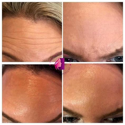 Botox For Forehead In Late 20s Before And After 6 Facial Injections