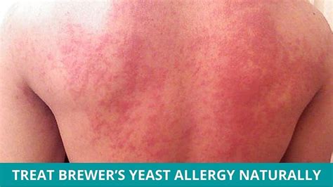 How To Treat Brewers Yeast Allergy Naturally