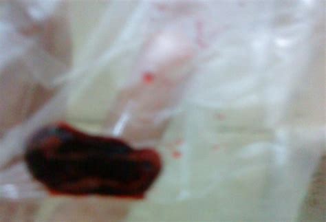 Haid atau yang dalam dunia medis dikenal dengan istilah menstruasi merupakan suatu periode pubertas yang menstruasi yang merupakan sebuah siklus alami pada wanita umumnya muncul setiap 4 minggu sekali yang ada yang datang lebih cepat dan ada juga yang datang lebih lambat. Bentuk Janin Yang Keluar Saat Keguguran - Berbagi Bentuk ...