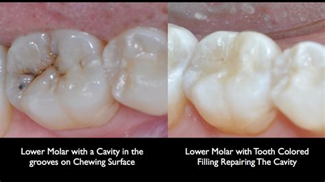 Tooth Colored Fillings Glendale Az Dentist Dr Lee Ann Brady