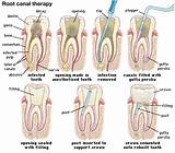 Root Canal Treatment Procedure Pictures Photos