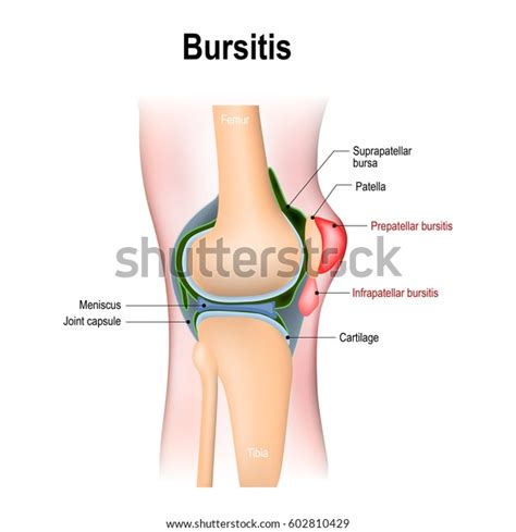 Bursitis Inflammation Bursae Synovial Fluid Prepatellar Stock Vector