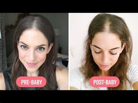 Top 100 Image When Does Postpartum Hair Loss Stop Vn