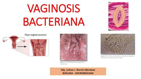 Vaginosis Bacteriana Silvia Eche Udocz