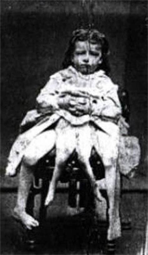 Myrtle Corbin Was A Four Legged Woman Who Had Five Kids Of Her Own