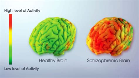Schizophrenia And Your Brain