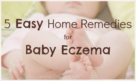 Baby Eczema Home Remedies
