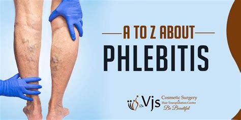 What Is Phlebitis How Is It Caused And Diagnosed How Is It Treated