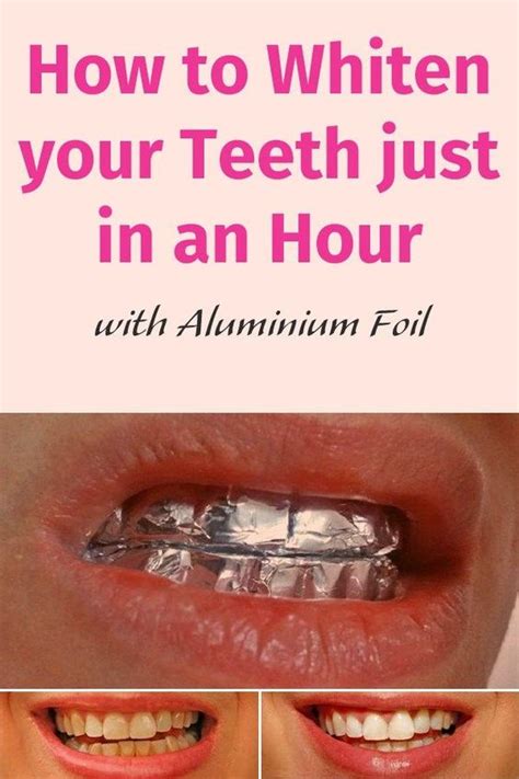 Learn about teeth stains, types of tooth discoloration, and how to better preserve your bright smile. Braces, Teeth and Aluminium foil on Pinterest