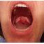 Causes And Treatment For A Swollen Uvula With Pictures  HealDove
