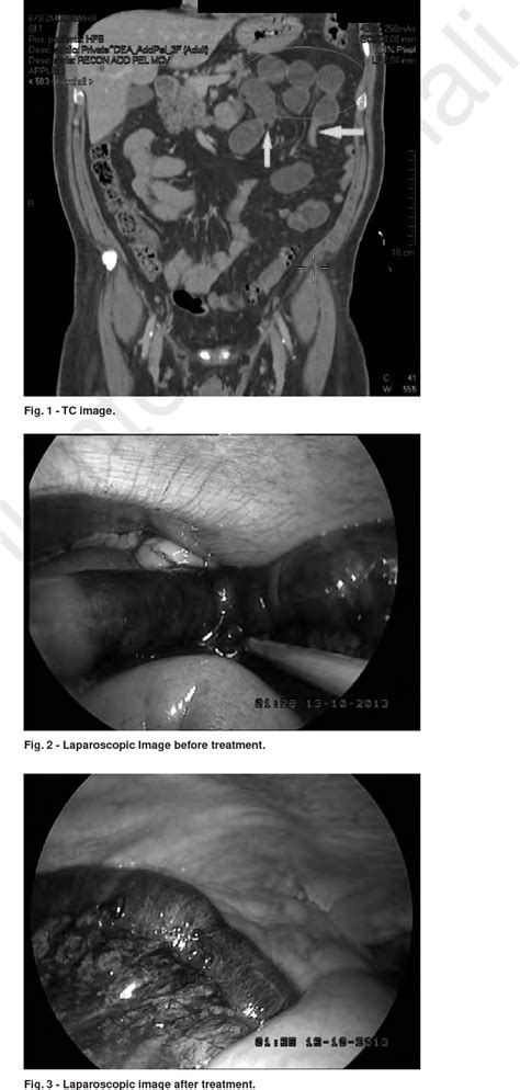 Figure 3 From Laparoscopic Management Of Left Paraduodenal Hernia Case