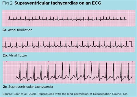 electrocardiogram 3 cardiac rhythm and conduction abnormalities nursing times