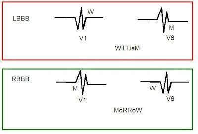 Bundle Branch Blocks Right Left Complete Vs Incomplete Medictests