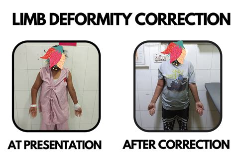 Limb Deformity Correction Dr Deepak Khurana Paediatric Orthopaedic