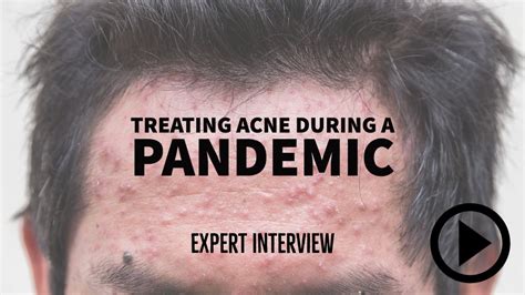 Dont Forget Acne Patients During Covid 19 Dermatology Times And