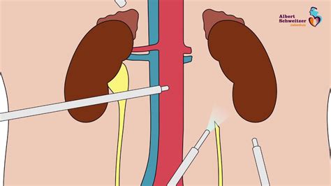 Laparoscopische Nefrectomie Het Verwijderen Van Een Nier Via Een