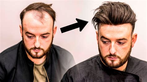 Mens Hair Loss Treatment Hairstyle Transformation Does It Work