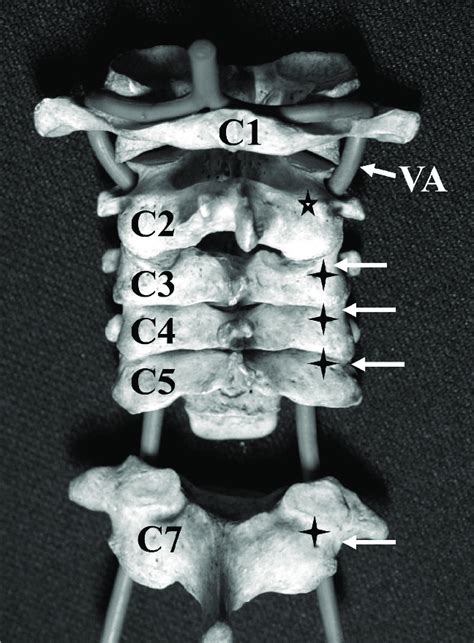 Pedicle Screw Starting Points In The Cervical Spine The Cranial Margin Download Scientific