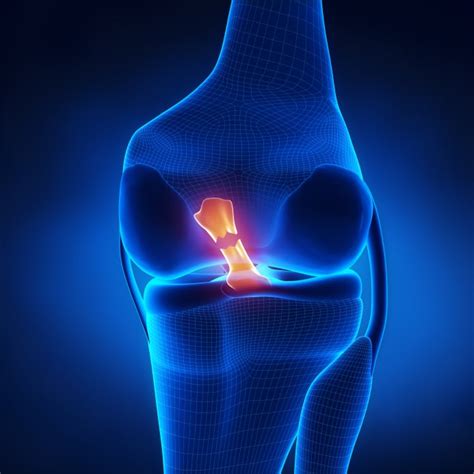 Frequently Asked Questions About Acl Reconstruction Surgery