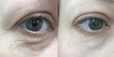 Laser For Under Eye Wrinkles Womens Aesthetics Physimed Medispa
