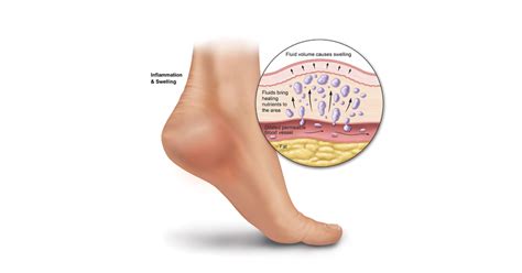 Swelling And Edema Of The Feet And Ankles Heel That Pain