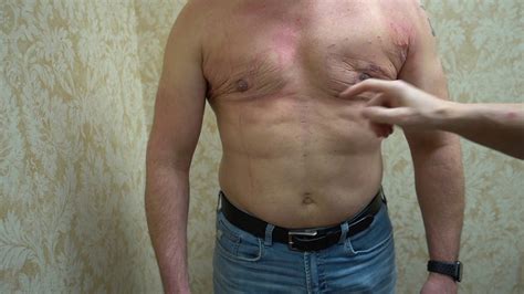 Fixing Gynecomastia Scar Tissue 48 Hours Post Op With Nipple