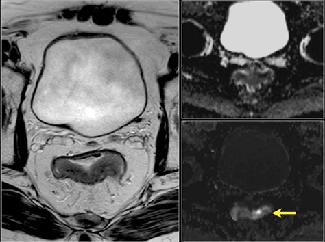 Rectal Cancer Staging Mri