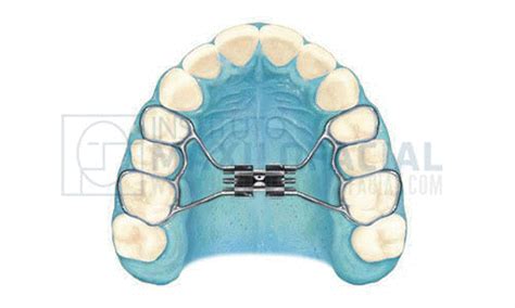 Expansión Rápida Del Maxilar O Expansión Palatina Instituto Maxilofacial