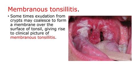 Tonsillitis Quinsy And Adenoiditis Ppt