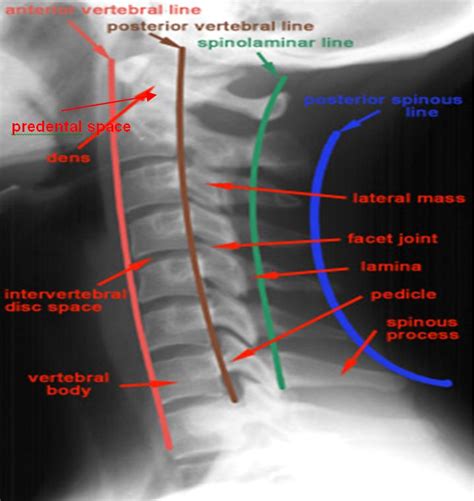 X Ray Skills 2 Cervical Spine X Ray Interpretation Basic Anatomy And