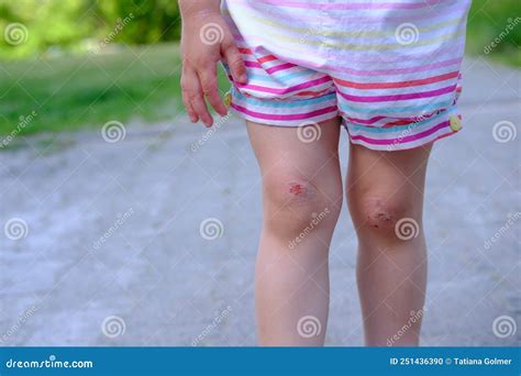 Fresh Wound Bleeding Abrasion On Knees Of Girl Child Fell On Walk