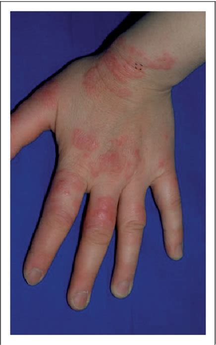 Figure 3 From Palisaded Neutrophilic And Granulomatous Dermatitis