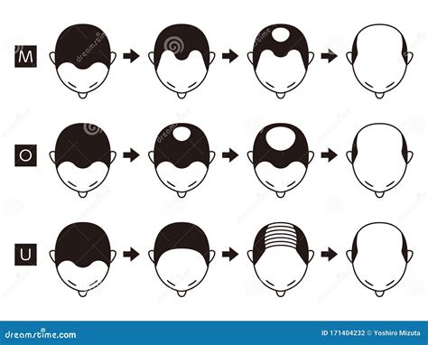Information Chart Of Hair Loss Stages And Types Of Baldness Illustrated