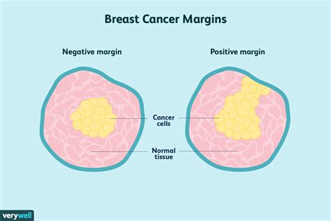 Understanding Surgical Margins In Breast Cancer