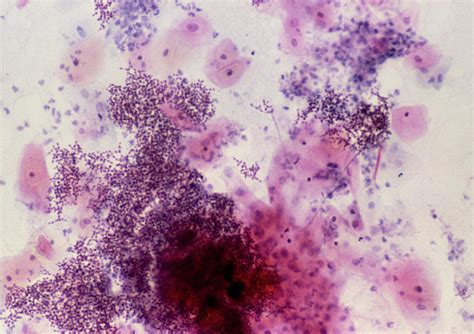Lm Of Cervical Smear With Thrush Infection Photograph By Science Photo