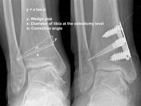 Prognostic Factors Affecting Correction Angle Changes After