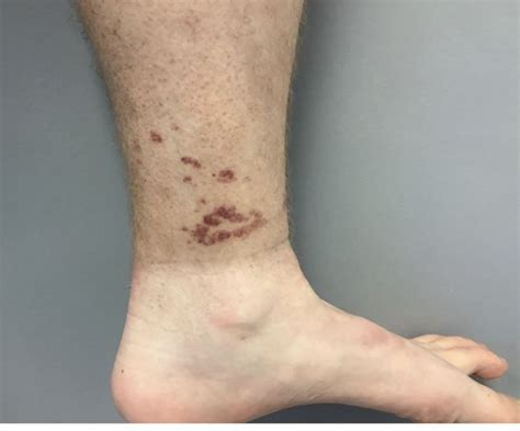 A Healthy White Male Presented With A Rash Consisting Of Erythematous