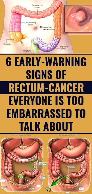 6 Early Warning Signs Of Rectum Cancer Everyone Is Too Embarrassed To