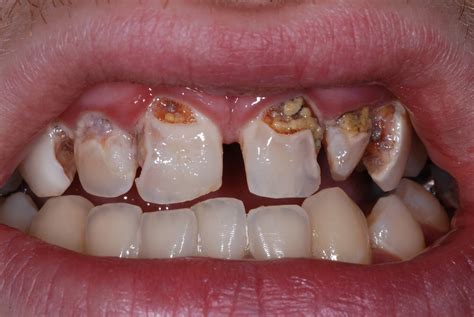Sciascia Dental Soda Pop Cavities