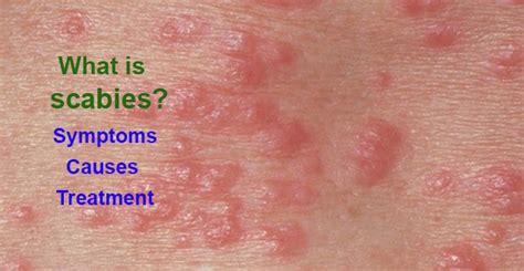 Scabies Causes Symptoms Treatment Pictures Images Vrogue Co