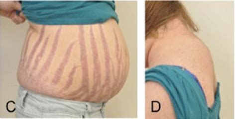 Cushing Syndrome Symptoms Pictures Causes Tests Treatment Healthmd