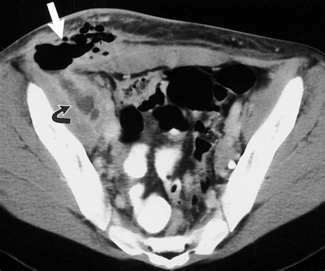 Crohn Disease Ct Scan Obtained With Oral And Intravenous Contrast