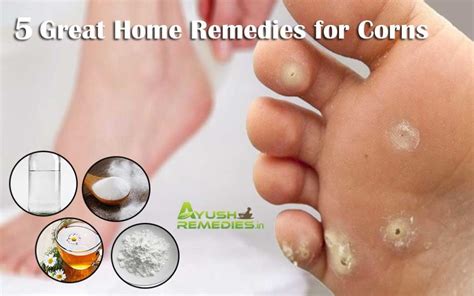5 Home Remedies For Corns On Feet Toes Hands And Fingers